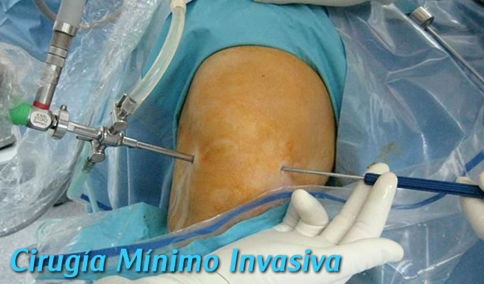 Cirugía de rodilla en Toluca y Metepec